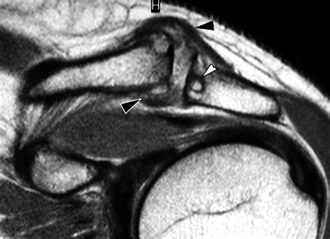 Mr Imaging Appearances Of Acromioclavicular Joint Dislocation