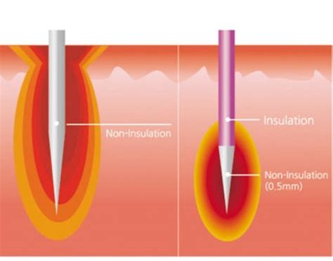 Micro Needling Radio Frequency | Venkat Center For Skin & Plastic Surgery