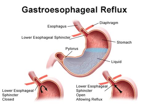 Gastroesophageal Reflux Disease Gastroenterology Of Greater Orlando