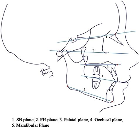 E Cephalometric Reference Planes Fig 3 E Linear Measurements