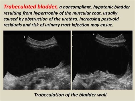 Presentation1.pptx, ultrasound examination of the urinary bladder and…