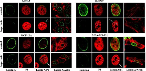 Differential Nuclear Shape Dynamics Of Invasive Andnon Invasive Breast