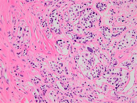 Pathology Outlines Clear Cell Sarcoma Of Soft Tissue