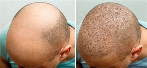 How Long After A Hair Transplant Can I Wear A Hat Aventus Clinic