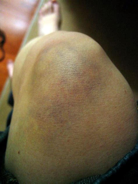 The Story Behind The Pictures: Day 133 - Bruised Knee