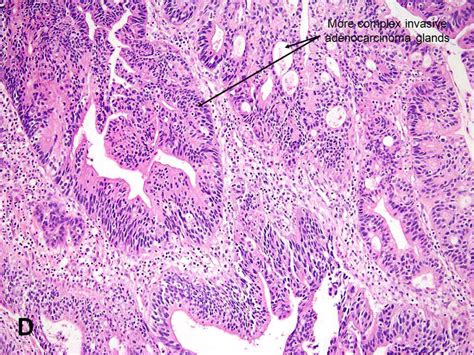 American Urological Association Primary Bladder Adenocarcinoma