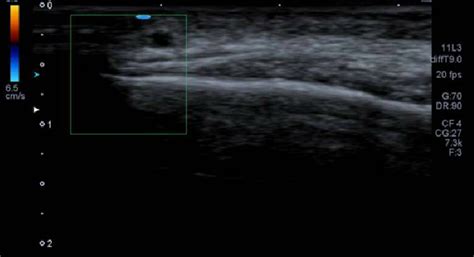 Doppler Ultrasound Of Temporal Arteries Without Alterations In Temporal