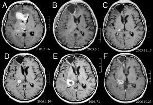 An Overview of Astrocytoma