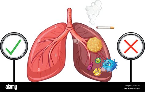 Healthy Lungs Hi Res Stock Photography And Images Alamy