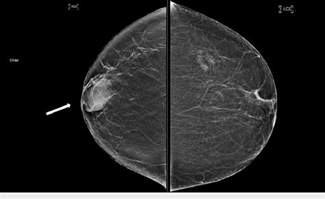 Right And Left Craniocaudal Views Bilateral Craniocaudal Views There