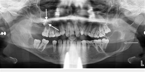 An Orthopantomogram Opg Shows The Maxillary And Mandibular Lesions