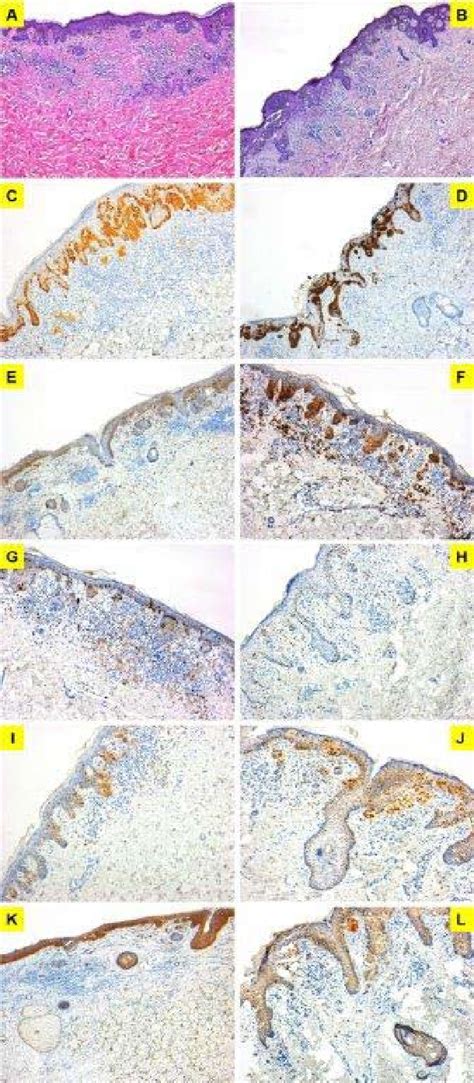 Figure 1 From Microinvasive Radial Growth Phase Of Cutaneous Melanoma