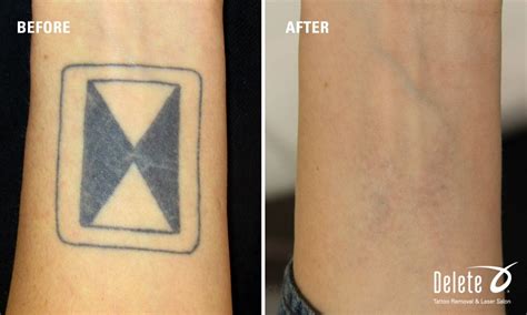 Mark Wahlberg Tattoo Removal Before And After Tattoo