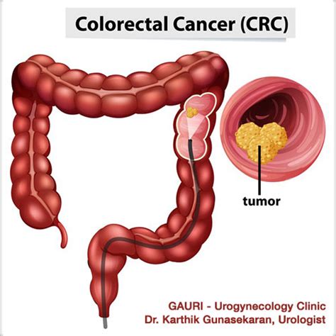 Colon Colorectal Cancer Symptoms And Diagnosis Gauri Urogynecology Clinic