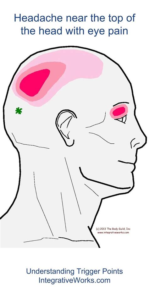 34 best images about Headache - Trigger Point Pain on Pinterest ...