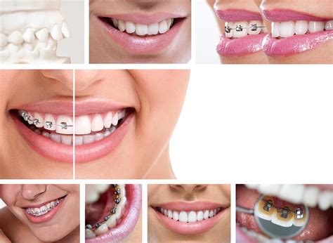 The Health Benefits Of Orthodontic Treatment