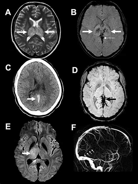 Cerebral Venous Thrombosis A Practical Guide Practical Neurology