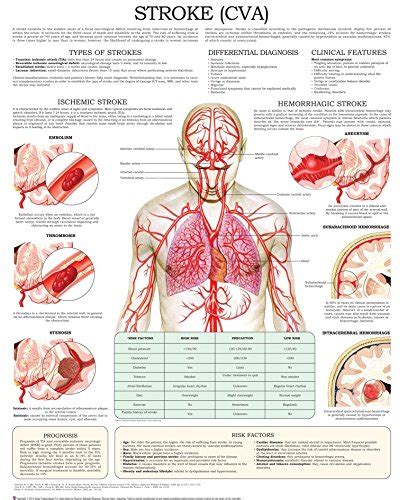 Understanding Stroke Laminated Anatomical Chart 2nd Edition | lupon.gov.ph