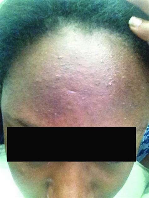 Fungal Folliculitis Causes Symptoms Diagnosis Treatment And Prognosis