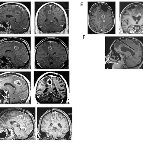 A Litt Only Complication 3 63 Year Old With A Lung Cancer Download Scientific Diagram