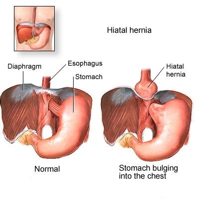 Hiatus Hernia: Hiatus Hernia Signs and symptoms: Self Help for Moving ...