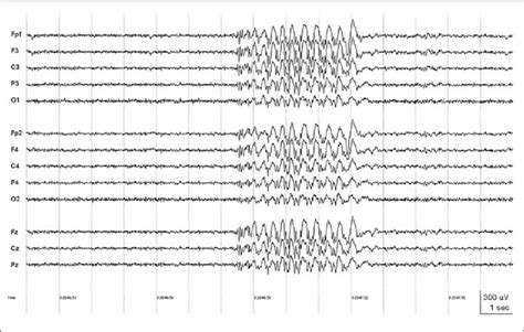 Patient J L Ictal Eeg Onset Of The Seizure In Videosequence