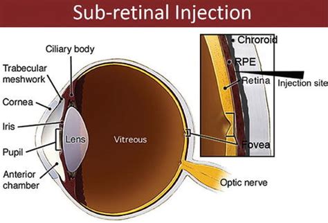 Subretinal Injections A Schematic Diagram Of The Eye Indicates The