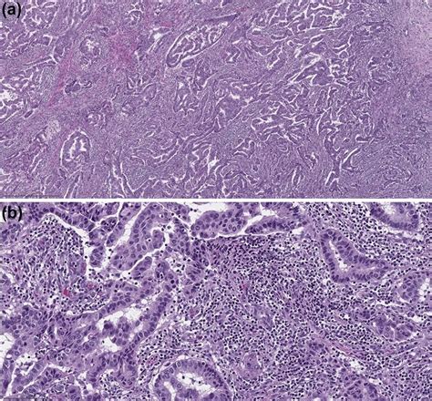 Example Of Tumor Infiltrating Lymphocytes In A Discordant Case