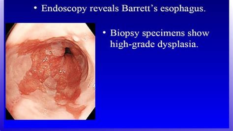 Barretts Esophagus Ppt