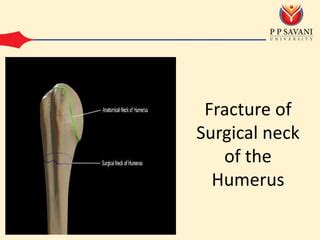 3. Fracture of Greater Tuberosity and Surgical Neck of Humerus | PPT