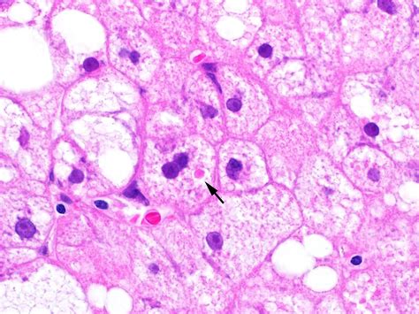 Pathology Outlines - Nonalcoholic fatty liver disease / nonalcoholic ...