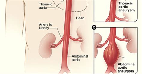 ABDOMINAL AORTIC ANEURYSM – Medical Centric