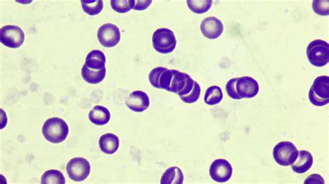 Rouleaux Formation In Blood Smear Youtube