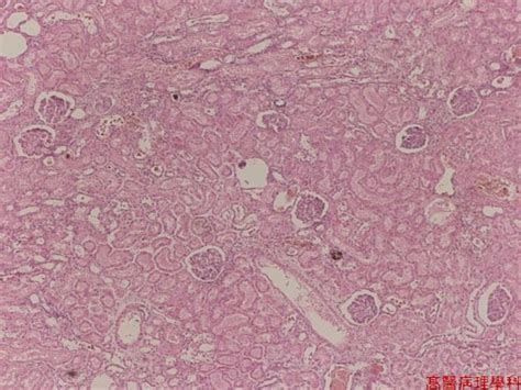 Kmu Pathology Lab《slide 1》cloudy Swelling Kidney