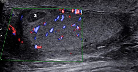 Acute Testicular Segmental Infarct Following Endovascular Repair Of A