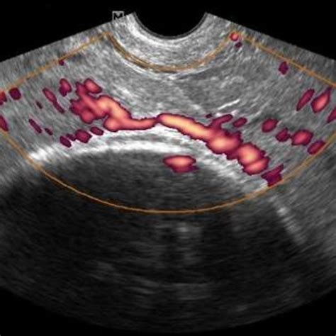 Transvaginal Ultrasound With Pulse Wave Doppler Showing Arterial