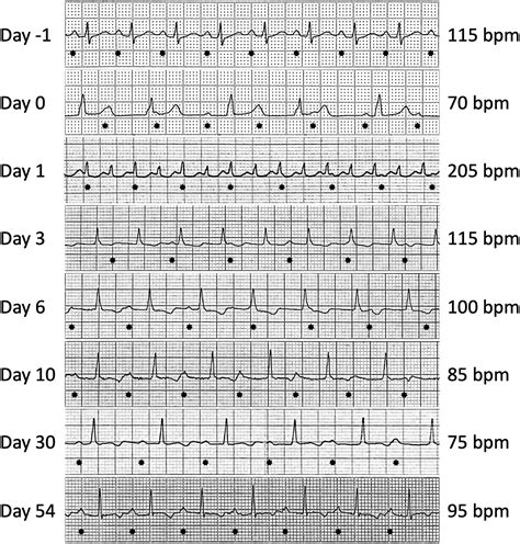 Junctional Ectopic Tachycardia And Late Recovery Of Postoperative