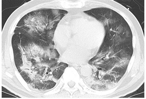 Chest CT At The Onset Of COVID 19 Showing Bilateral Patchy Groundglass