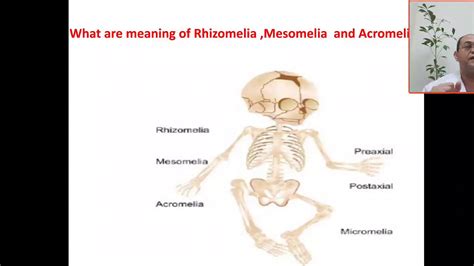 What Are The Meaning Or The Difference Between Rhizomelia Mesomelia