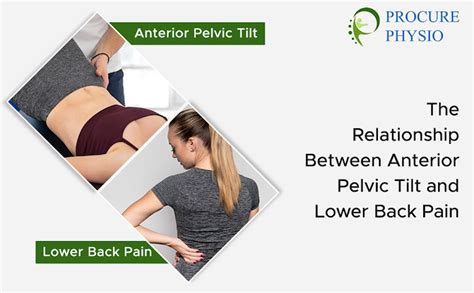 The Relationship Between Anterior Pelvic Tilt And Lower Back Pain