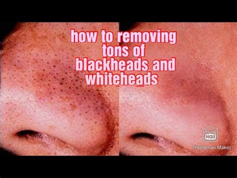 How To Remove Tons Of Blackheads And Whiteheads Instantly Youtube