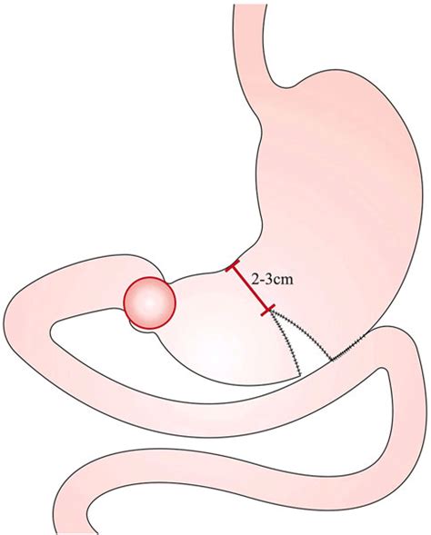 Loop Gastrojejunostomy