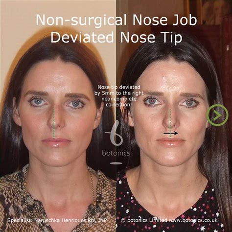 Non Surgical Nose Job Before And After Mignon Satterfield