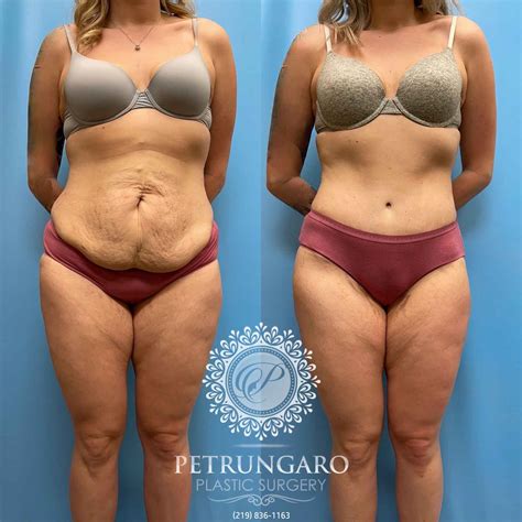 Tummy Tuck Lipo Petrungaro Plastic Surgery