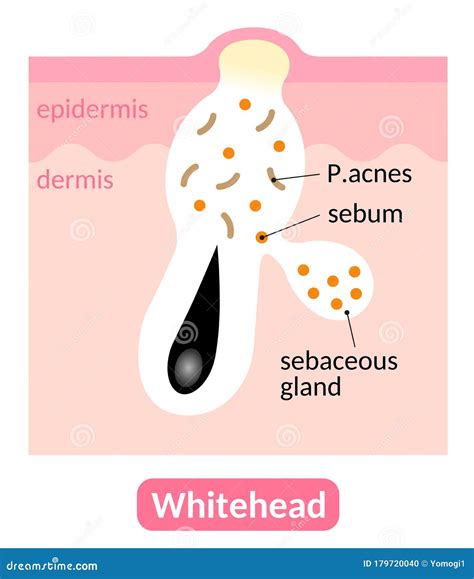 Whiteheads Are Types Of Acne Pimples Which Are Closed Within The Pore