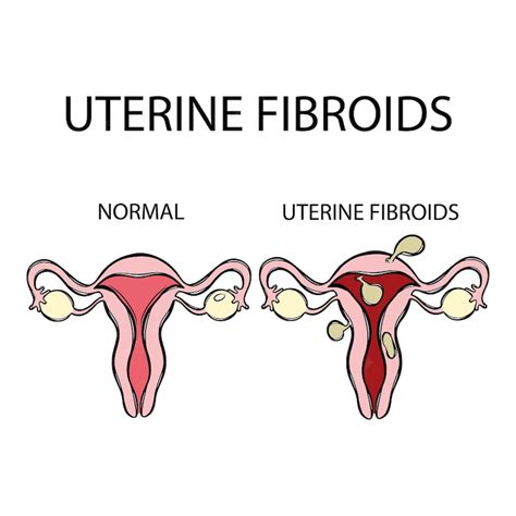 Premium Vector Uterine Fibroids Vs Normal Female Reproductive