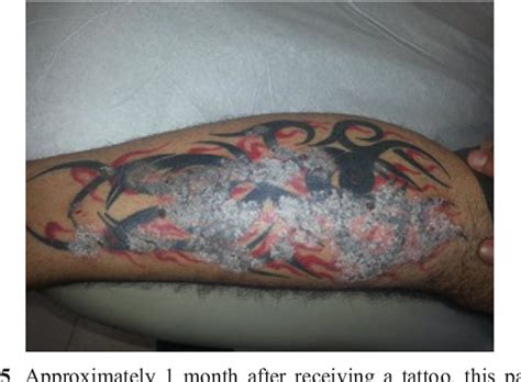 Psoriasis And Tattoos A Comprehensive View Muoi Damon