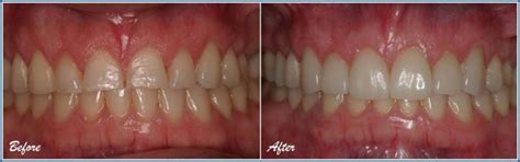 Gum Bleaching Before Afters Southland Dental Care