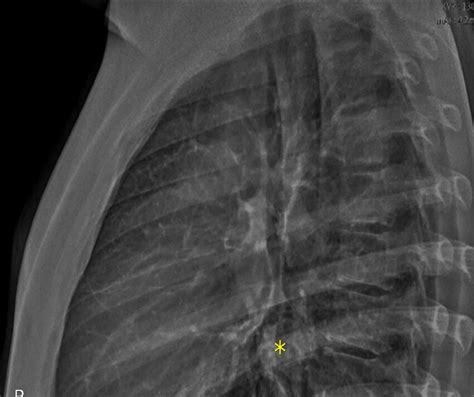 Radiografía De Tórax Con Proyecciones Pa A Y Lateral B Imagen