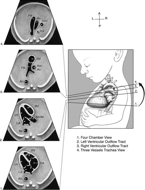 Diagnosis And Treatment Of Fetal Cardiac Disease Circulation